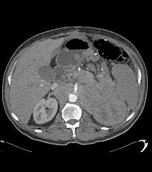 Neuroendocrine Tumor of the Pancreas Invades the Left Kidney - CTisus CT Scan