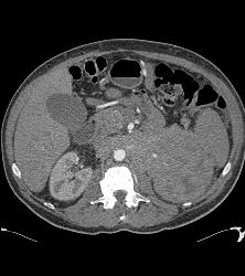 Neuroendocrine Tumor of the Pancreas Invades the Left Kidney - CTisus CT Scan