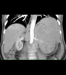 Neuroendocrine Tumor of the Pancreas Invades the Left Kidney - CTisus CT Scan