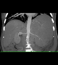 Recurrent Left Renal Cell Carcinoma With Incredible Adenopathy - CTisus CT Scan