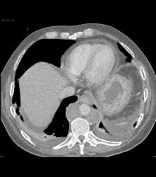 Recurrent Left Renal Cell Carcinoma With Incredible Adenopathy - CTisus CT Scan