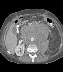 Recurrent Left Renal Cell Carcinoma With Incredible Adenopathy - CTisus CT Scan