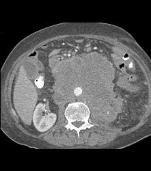 Recurrent Left Renal Cell Carcinoma With Incredible Adenopathy - CTisus CT Scan