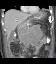 Recurrent Left Renal Cell Carcinoma With Incredible Adenopathy - CTisus CT Scan