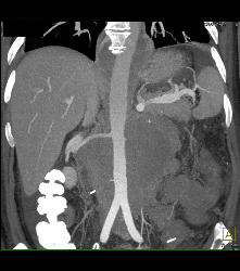 Recurrent Left Renal Cell Carcinoma With Incredible Adenopathy - CTisus CT Scan