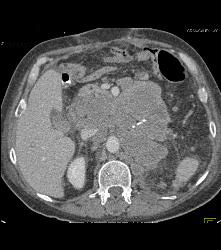 Recurrent Left Renal Cell Carcinoma With Incredible Adenopathy - CTisus CT Scan