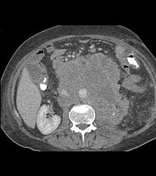 Recurrent Left Renal Cell Carcinoma With Incredible Adenopathy - CTisus CT Scan