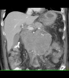 Recurrent Left Renal Cell Carcinoma With Incredible Adenopathy - CTisus CT Scan