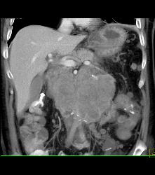 Recurrent Left Renal Cell Carcinoma With Incredible Adenopathy - CTisus CT Scan