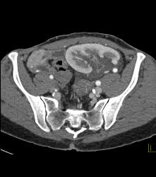 Perirenal Prominence Near Renal Transplant- Multiple Visualizations. Patient Also Has A Pancreatic Transplant - CTisus CT Scan