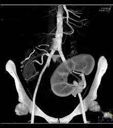 Perirenal Prominence Near Renal Transplant- Multiple Visualizations. Patient Also Has A Pancreatic Transplant - CTisus CT Scan