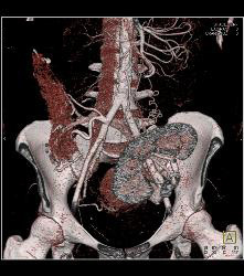 Perirenal Prominence Near Renal Transplant- Multiple Visualizations. Patient Also Has A Pancreatic Transplant - CTisus CT Scan