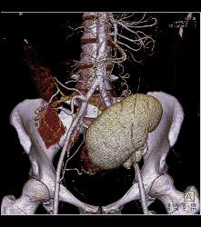 Perirenal Prominence Near Renal Transplant- Multiple Visualizations. Patient Also Has A Pancreatic Transplant - CTisus CT Scan