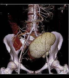 Perirenal Prominence Near Renal Transplant- Multiple Visualizations. Patient Also Has A Pancreatic Transplant - CTisus CT Scan