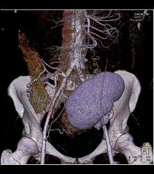 Perirenal Prominence Near Renal Transplant- Multiple Visualizations. Patient Also Has A Pancreatic Transplant - CTisus CT Scan