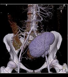 Perirenal Prominence Near Renal Transplant- Multiple Visualizations. Patient Also Has A Pancreatic Transplant - CTisus CT Scan