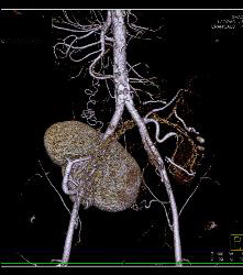 Perirenal Prominence Near Renal Transplant- Multiple Visualizations. Patient Also Has A Pancreatic Transplant - CTisus CT Scan