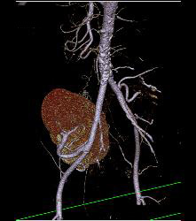 Perirenal Prominence Near Renal Transplant- Multiple Visualizations. Patient Also Has A Pancreatic Transplant - CTisus CT Scan