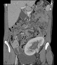 Perirenal Prominence Near Renal Transplant- Multiple Visualizations. Patient Also Has A Pancreatic Transplant - CTisus CT Scan