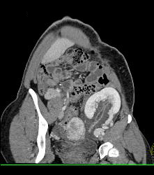 Perirenal Prominence Near Renal Transplant- Multiple Visualizations. Patient Also Has A Pancreatic Transplant - CTisus CT Scan