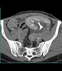 Perirenal Prominence Near Renal Transplant- Multiple Visualizations. Patient Also Has A Pancreatic Transplant - CTisus CT Scan