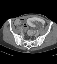 Perirenal Prominence Near Renal Transplant- Multiple Visualizations. Patient Also Has A Pancreatic Transplant - CTisus CT Scan