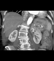 Right Adrenal Metastases From Renal Cell Carcinoma - CTisus CT Scan