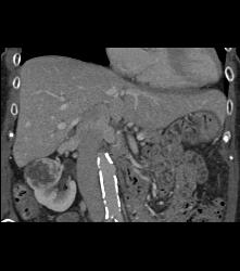 Right Adrenal Metastases From Renal Cell Carcinoma - CTisus CT Scan