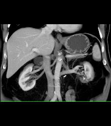 Retroaortic Left Renal Vein - CTisus CT Scan