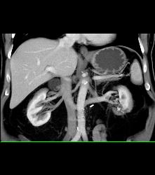 Retroaortic Left Renal Vein - CTisus CT Scan