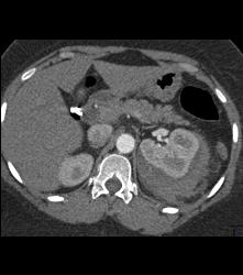 Perirenal Hematoma - CTisus CT Scan