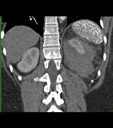 Perirenal Hematoma - Kidney Case Studies - CTisus CT Scanning