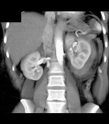 Perirenal Hematoma - CTisus CT Scan