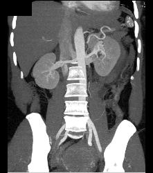 Perirenal Hematoma - CTisus CT Scan