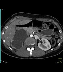 Right Ureteropelvic Junction (UPJ) Due to Crossing Vessel- See CTA Sequence - CTisus CT Scan