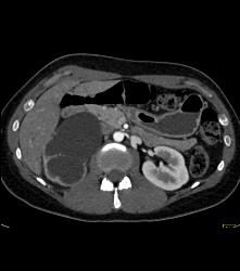 Right Ureteropelvic Junction (UPJ) Due to Crossing Vessel- See CTA Sequence - CTisus CT Scan