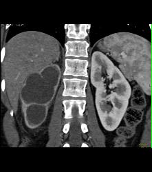 Right Ureteropelvic Junction (UPJ) Due to Crossing Vessel- See CTA Sequence - CTisus CT Scan