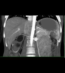 Right Ureteropelvic Junction (UPJ) Due to Crossing Vessel- See CTA Sequence - CTisus CT Scan