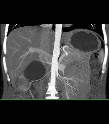 Right Ureteropelvic Junction (UPJ) Due to Crossing Vessel- See CTA Sequence - CTisus CT Scan