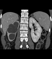 Right Ureteropelvic Junction (UPJ) Due to Crossing Vessel- See CTA Sequence - CTisus CT Scan