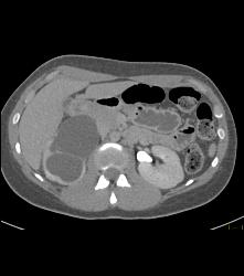 Right Ureteropelvic Junction (UPJ) Due to Crossing Vessel- See CTA Sequence - CTisus CT Scan