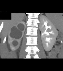 Right Ureteropelvic Junction (UPJ) Due to Crossing Vessel- See CTA Sequence - CTisus CT Scan