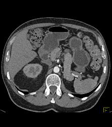 S/p Left Nephrectomy - CTisus CT Scan