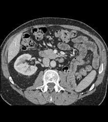 S/p Left Nephrectomy - CTisus CT Scan