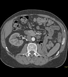 S/p Left Nephrectomy - CTisus CT Scan