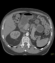 S/p Left Nephrectomy - CTisus CT Scan