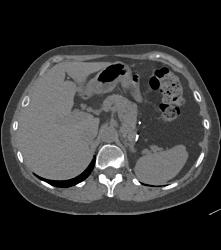 Recurrent Renal Cell Carcinoma Near Left Nephrectomy Site - CTisus CT Scan