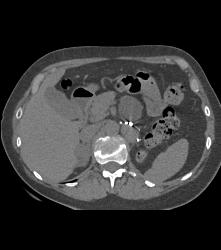 Recurrent Renal Cell Carcinoma Near Left Nephrectomy Site - CTisus CT Scan