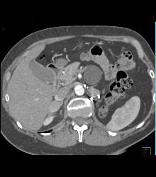 Recurrent Renal Cell Carcinoma Near Left Nephrectomy Site - CTisus CT Scan