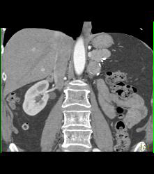 Recurrent Renal Cell Carcinoma Near Left Nephrectomy Site - CTisus CT Scan